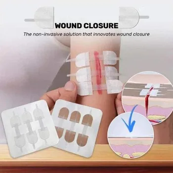 3pcs Āra Šūšanas-bezmaksas Band-aid, Rāvējslēdzēju Tips Band-atbalsti, Lai Ātri Šuvju Brūces Apturēt Asiņošanu Novērstu Infekcijas Veselības Aprūpes